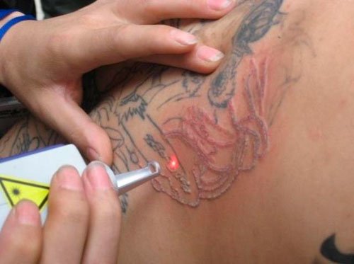 Laser tattoo removal kidderminster